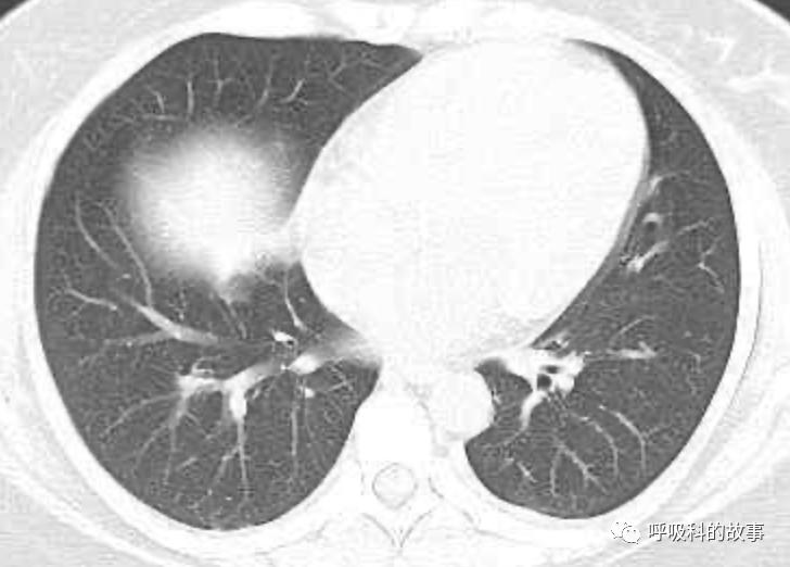 五花八门的发热之一—药物热（1）