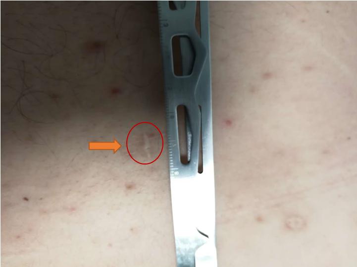 【谈骨论筋】我的腰椎做了微创手术为什么还会痛？一文带你了解术后疼痛原因及防治方法