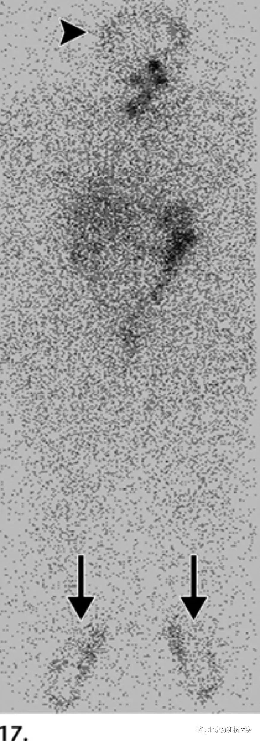 碘扫描最坏的结果,放射性核素扫描可以鉴别诊断吗