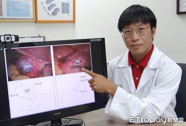输卵管结扎术后还能再怀孕吗,输卵管结扎了如何才能再怀孕