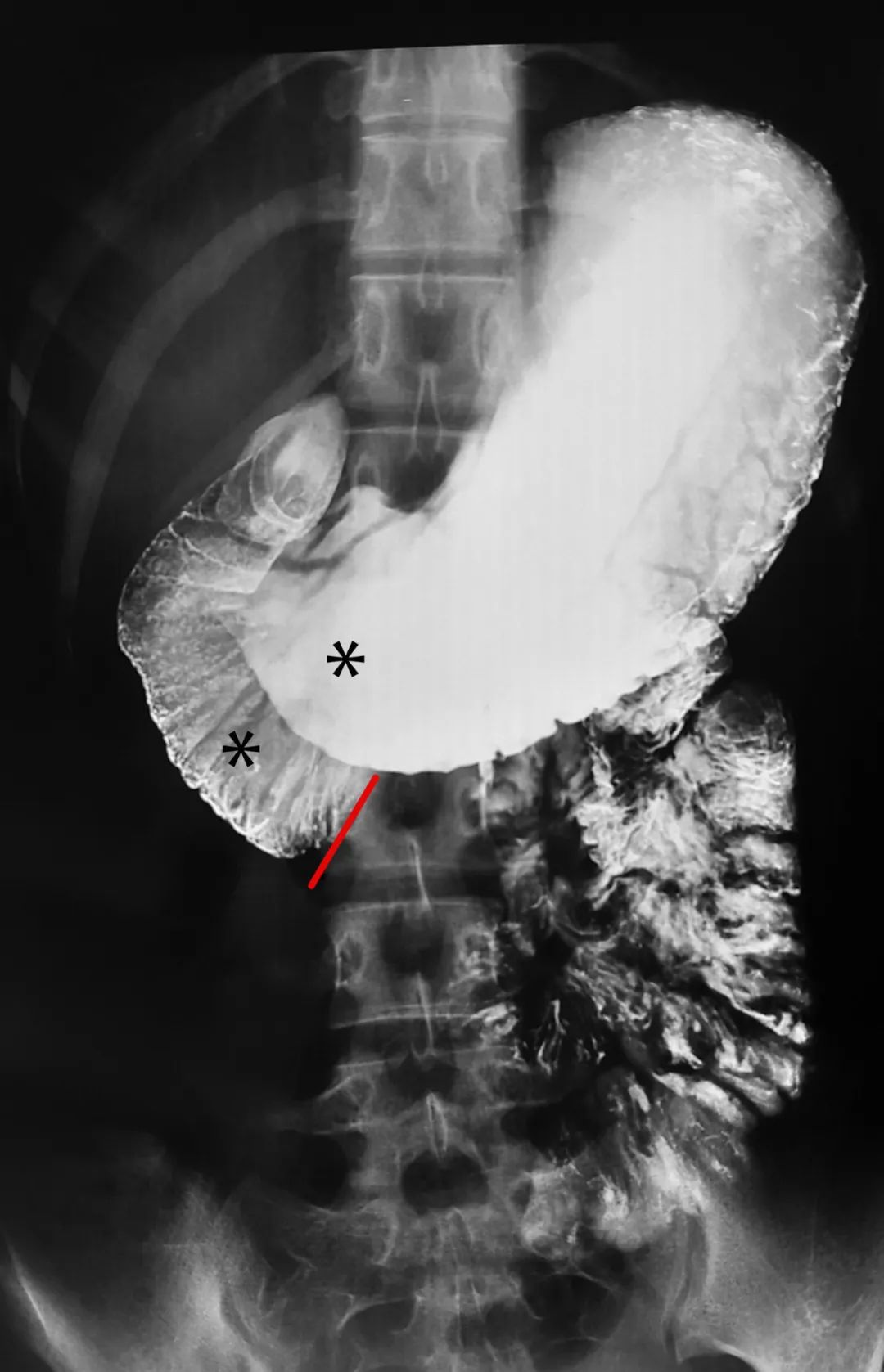 肠系膜上动脉综合征治疗,肠系膜上动脉综合征发生在哪
