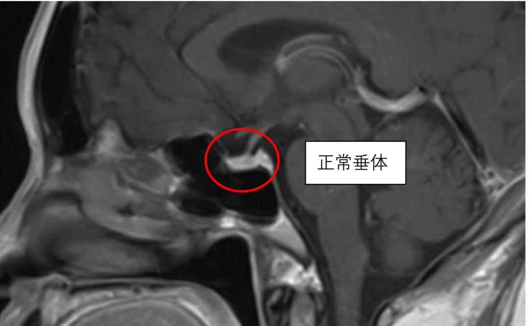 47岁女士以为当奶奶累得更年期提前，一查竟是脑子里长了个“雪人”