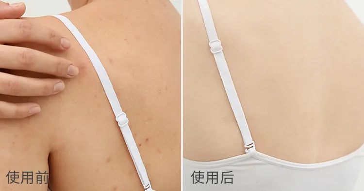 三伏天艾草熏后背多久熏一次,三伏天用艾草泡澡几天泡一次