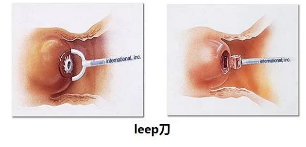 给宫颈拍个照就让你做leep刀？转身就跑吧
