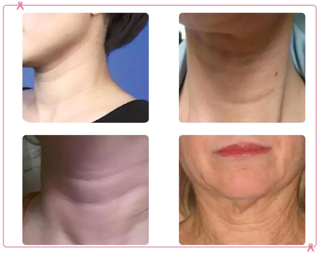 女人脖子有颈纹和年龄有关吗,一条颈纹代表二十岁