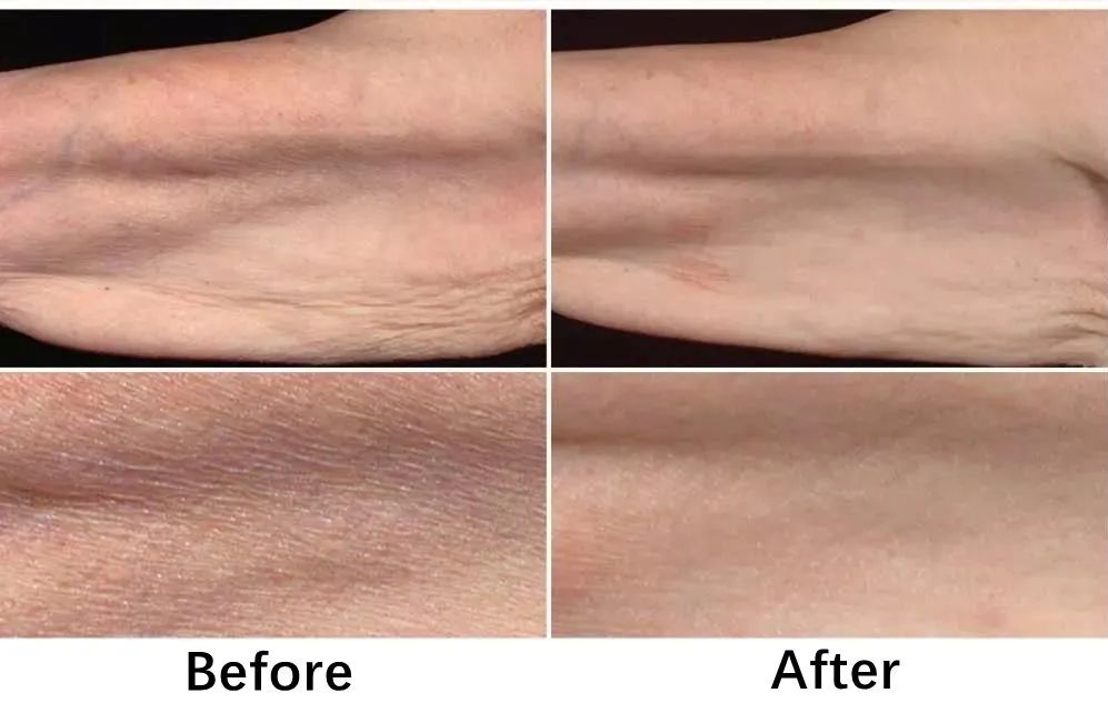 一条颈纹老十岁教你一招淡化,女人脖子有颈纹和年龄有关吗