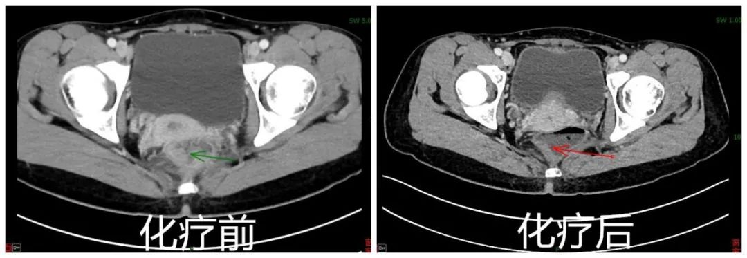直肠癌已确诊，医生却说不要急着做手术？我需要一个合理解释！