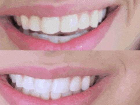 瑞士国民牙膏治牙敏感,牙齿酸用抗敏感牙膏有效