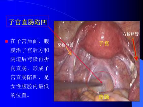 盆腔积液一定要做阴超吗,盆腔积液一定要处理吗