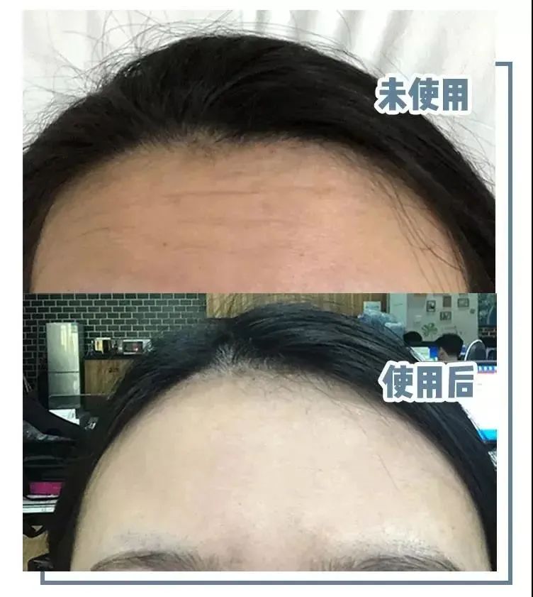 抬头纹眉间纹怎么去除,眉间纹抬头纹去除最好的方法