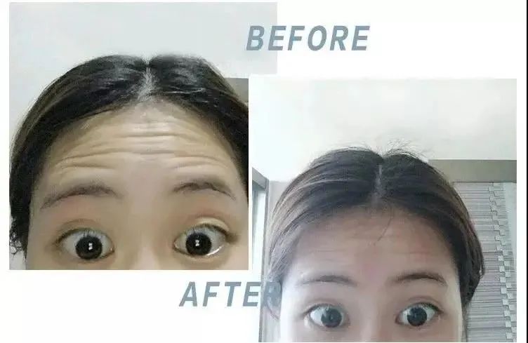 抬头纹眉间纹怎么去除,眉间纹抬头纹去除最好的方法
