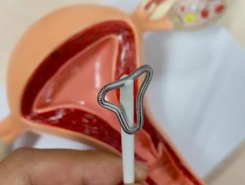 人体取出的节育环,体内节育环30年了还能取吗