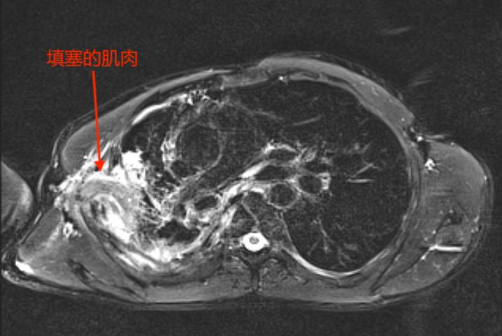 用他自己的肌肉塞进胸腔?甘肃农民为治病跨越大半中国,最终在杭州得救