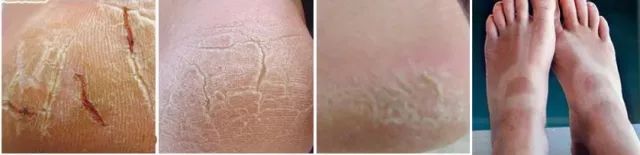 你穿高跟鞋经历过磨脚的痛苦吗,穿高跟鞋脚掌死皮怎么去除