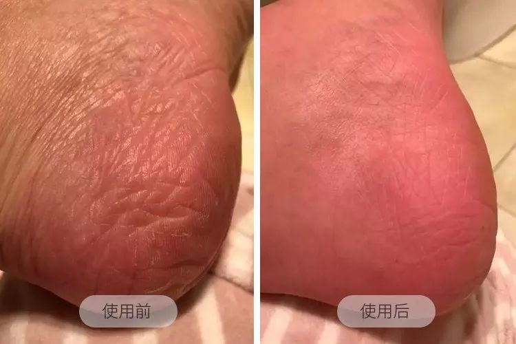 你穿高跟鞋经历过磨脚的痛苦吗,穿高跟鞋脚掌死皮怎么去除