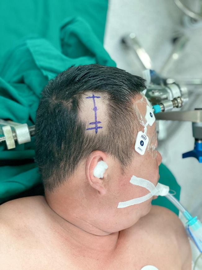 清华长庚神经外科手术,宣武医院治疗脑出血擅长