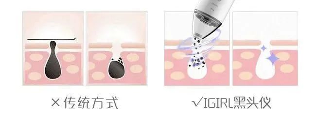 痘痘闭口挤出来的是什么,闭口痘痘挤出来白色物质