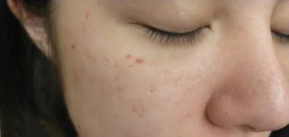 痘痘挤出黄水还是血水,痘痘挤出来的白色乳浆是什么