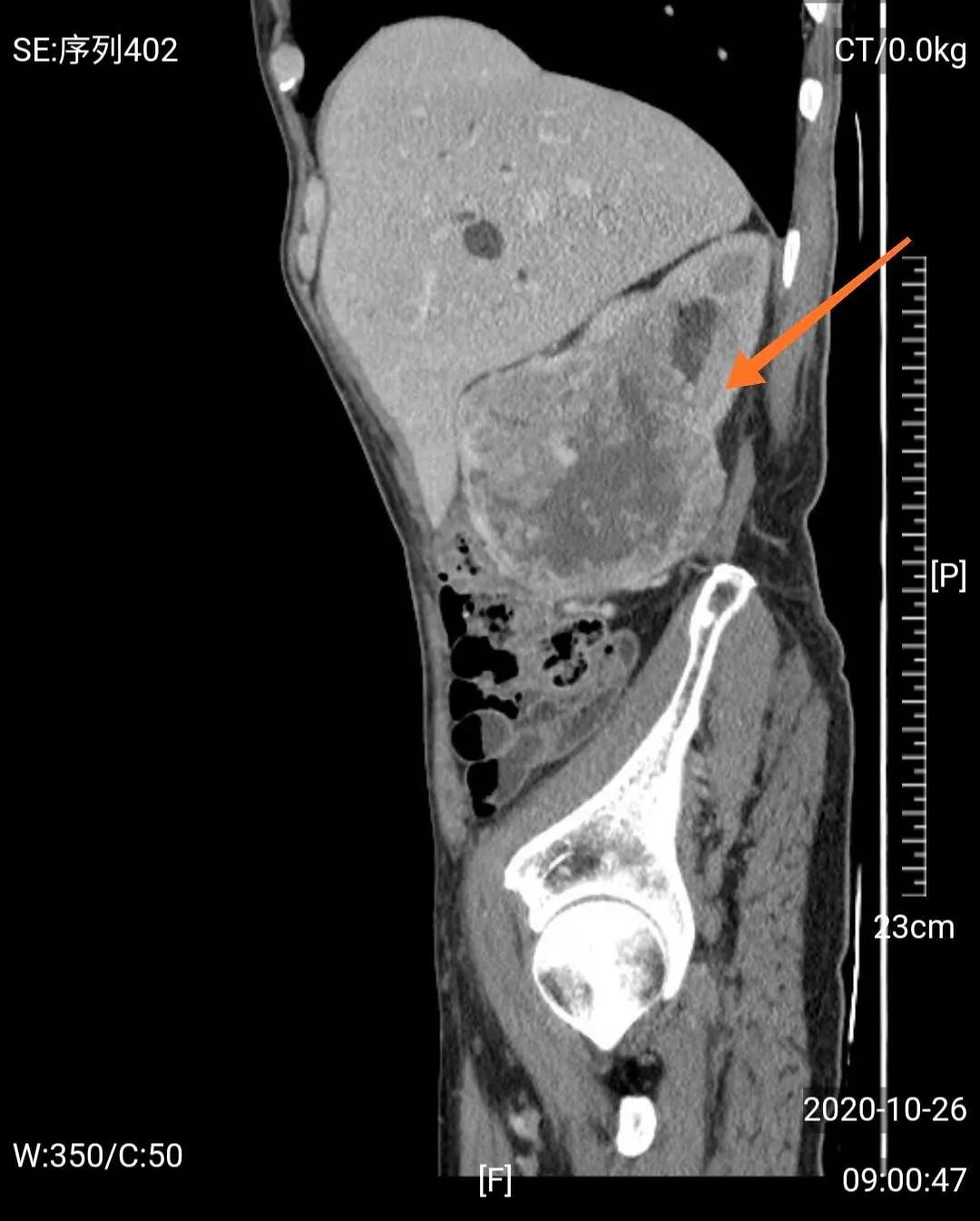 【警惕】耄耋老人患巨大肾癌，佛中医泌外团队3D腹腔镜微创治愈