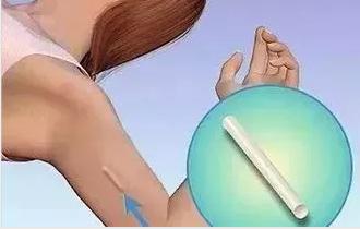 济南皮下埋植避孕针,皮下植入剂避孕怎么做