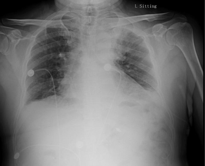 房颤术后出现胸闷气喘咳嗽,房颤消融术后2个月胸痛怎么办