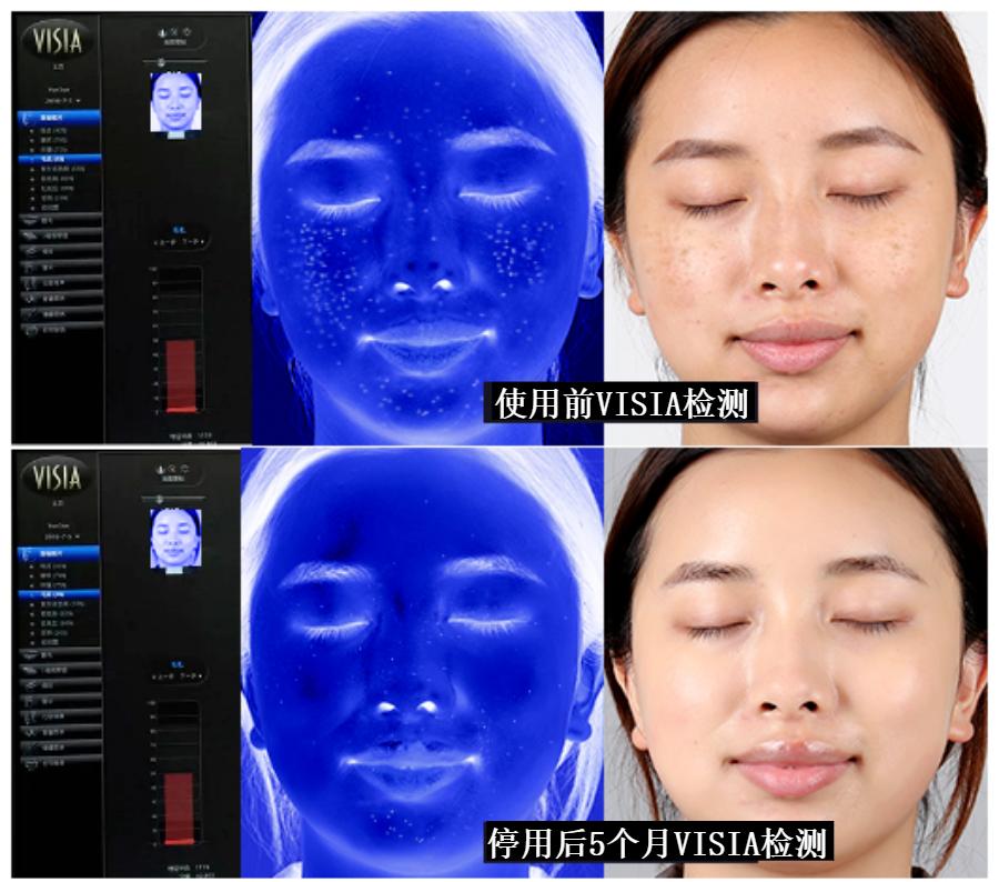 花了3万做激光,才彻底懂了:医生为什么劝你别去斑