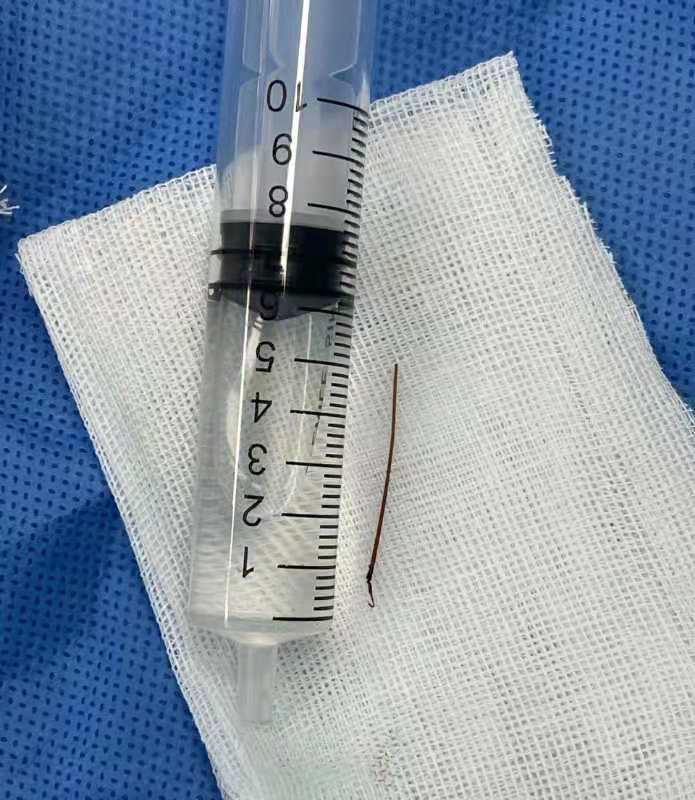 小孩子被刺给扎到怎么办,小孩被扎29针