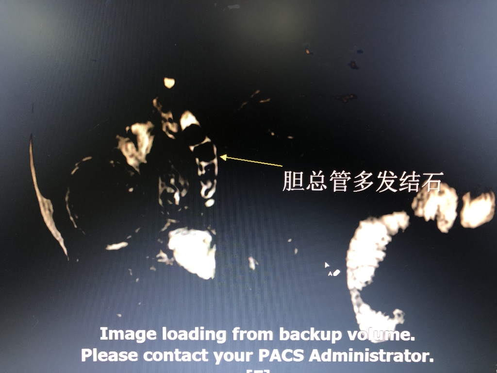 高龄胆管炎治疗,93岁老人胆管结石手术要命