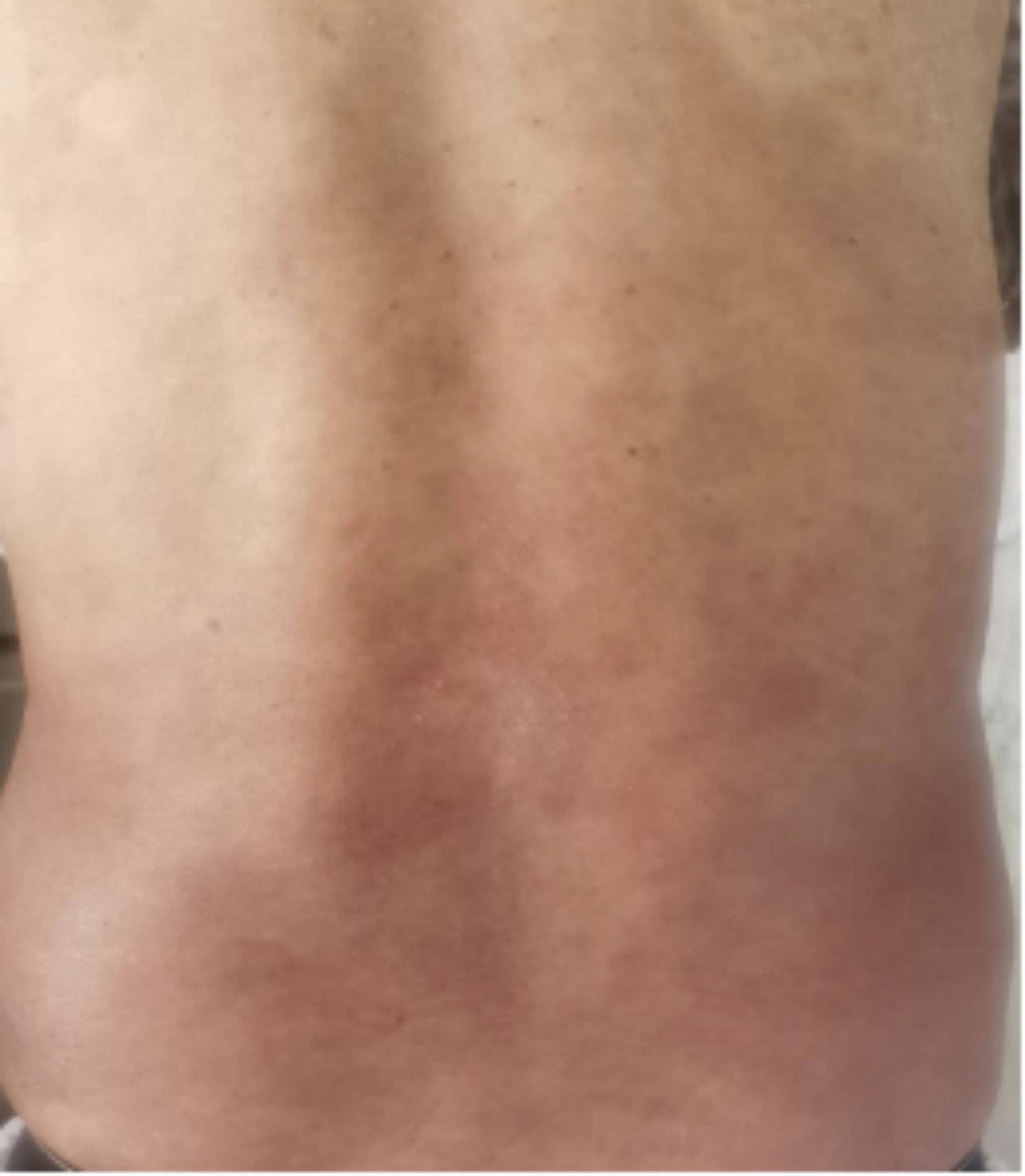 七旬香港阿叔受银屑病困扰10年，在中山七院获得有效救治