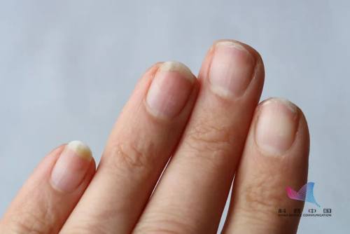 脚指甲变厚有竖纹是怎么回事,脚趾甲变黄变厚有竖纹是咋回事