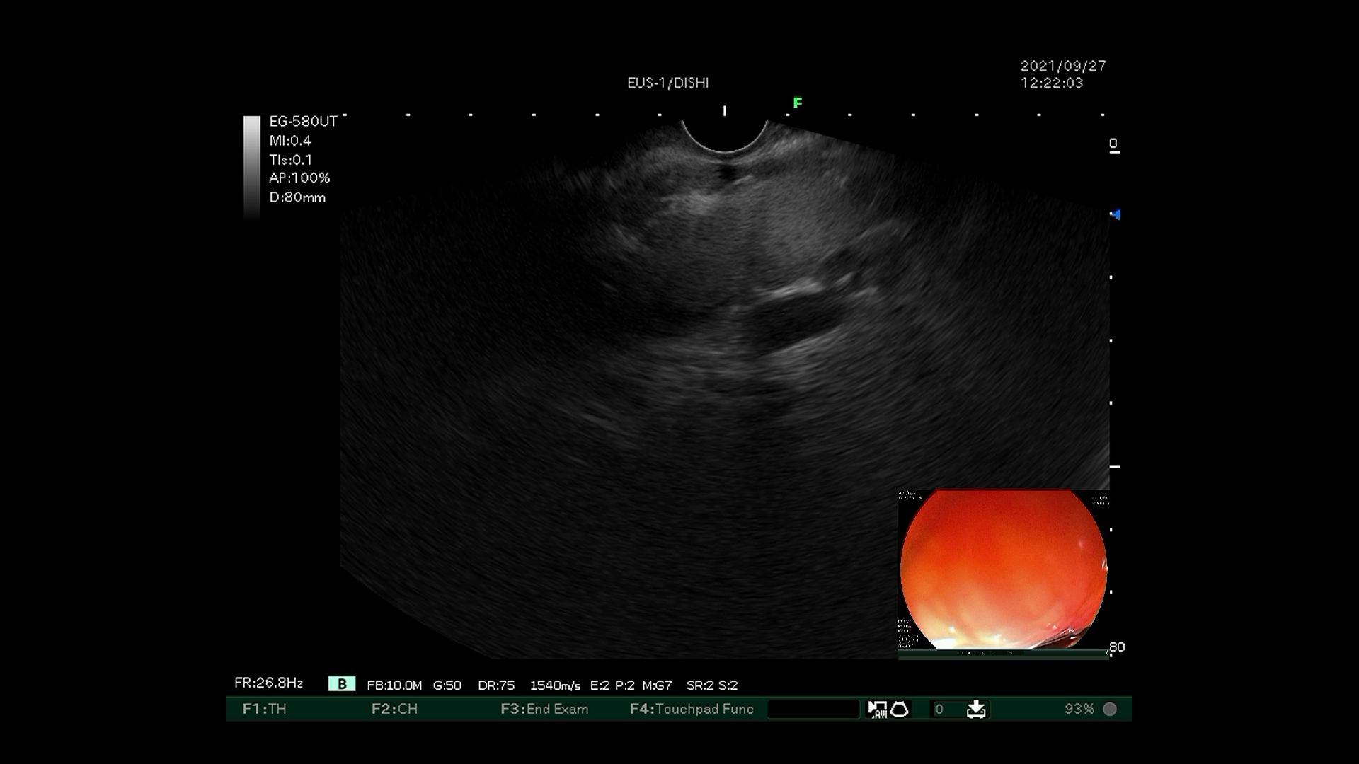 毓璜顶医院国内领先开展超声内镜引导下弹簧圈置入联合组织胶栓塞术治疗伴自发分流的巨大胃底静脉曲张