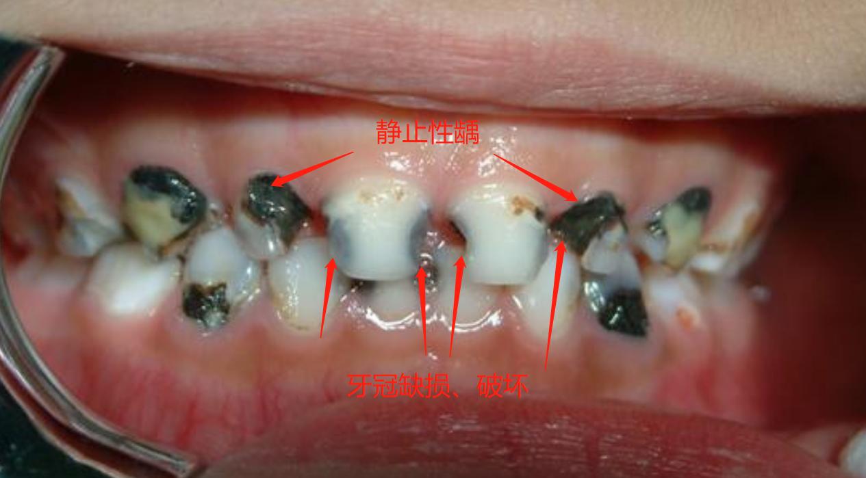 宝宝门牙发黑怎么根管治疗,宝宝门牙变黑是什么原因