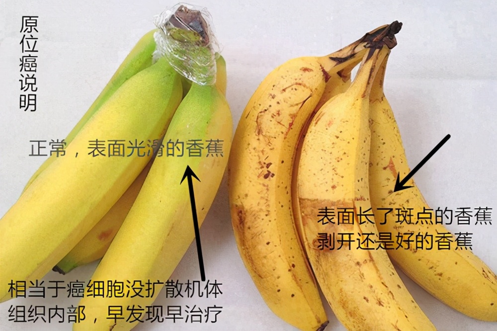 原位癌和微浸润癌可以治愈吗,原位癌浸润癌和微浸润癌区别