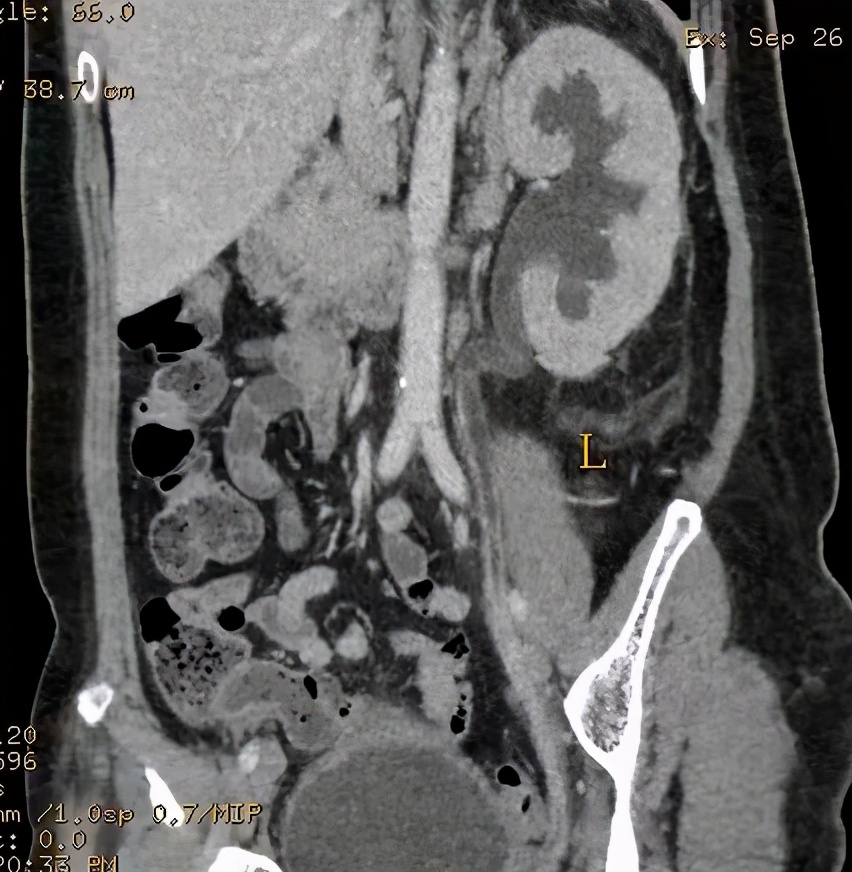 尿路造影输尿管间断显影,静脉尿路造影和排泄性尿路造影