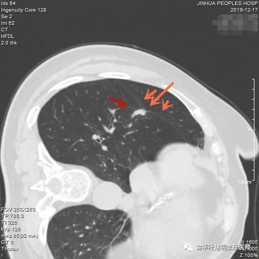 叶建明谈胸膜下的实性结节,叶建明肺实性良性结节会变癌症吗