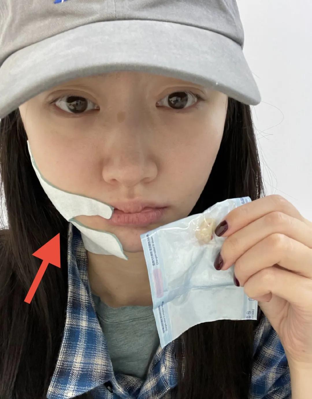 景甜素颜曝光认不出，自拍双眼皮疤痕明显，曾大方承认自己整容