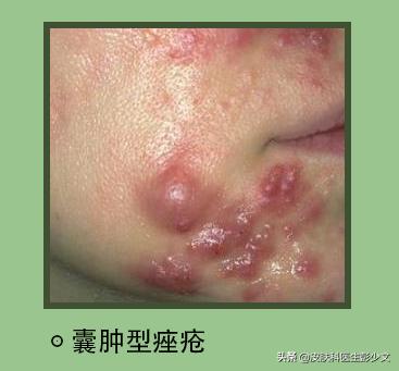 痘疮怎么治疗最快啊,身体长痘长疮怎么办最快消除