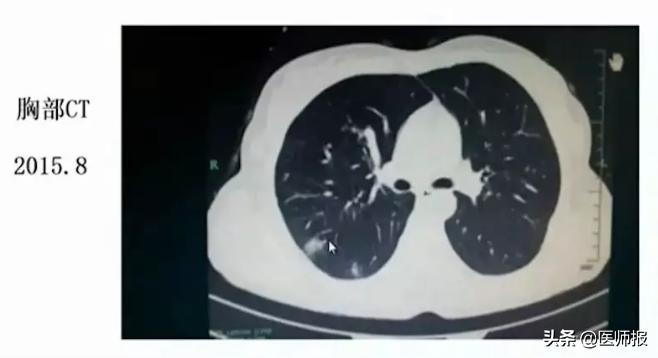 反复咳血持续一年了是肺癌吗,反复咳嗽有痰是肺炎的前兆吗