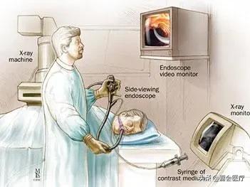 取胆管结石不用开刀，ERCP神奇在哪里？