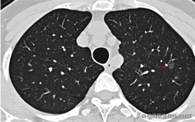2厘米肺结节打消炎针能变小吗,肺结节5mm一年后去检查变小