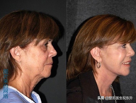 做拉皮手术的亲身经历告诉你,揭秘拉皮手术的4个真相
