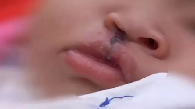 产检小孩唇腭裂是为什么,发现胎儿唇裂孕期补救办法
