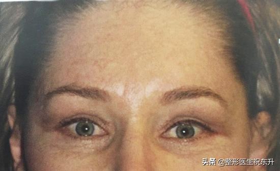 眉上内窥镜提眉视频全过程,内镜提眉