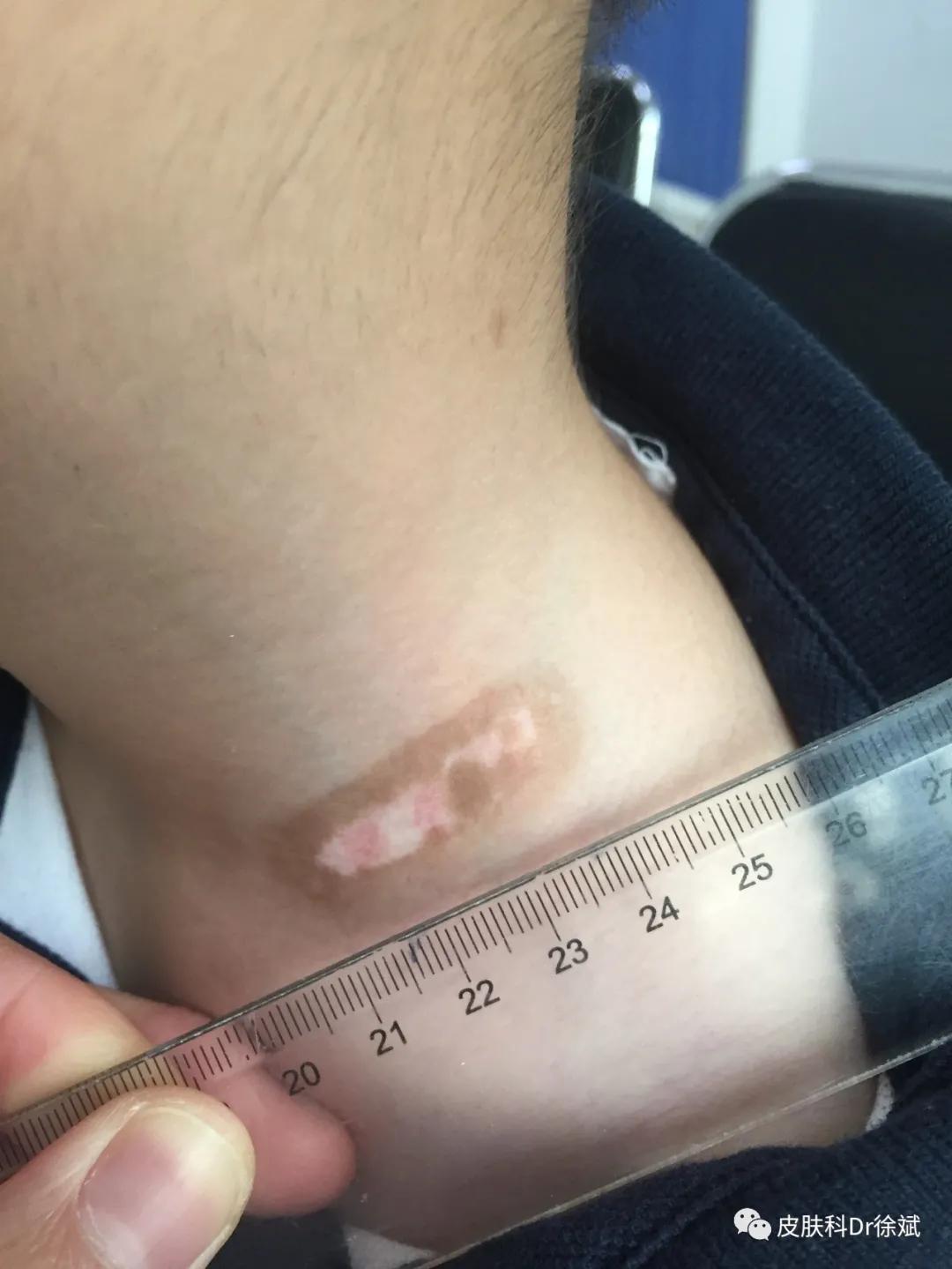 儿童治疗白癜风需要多少钱,uvb治疗白癜风多久见效