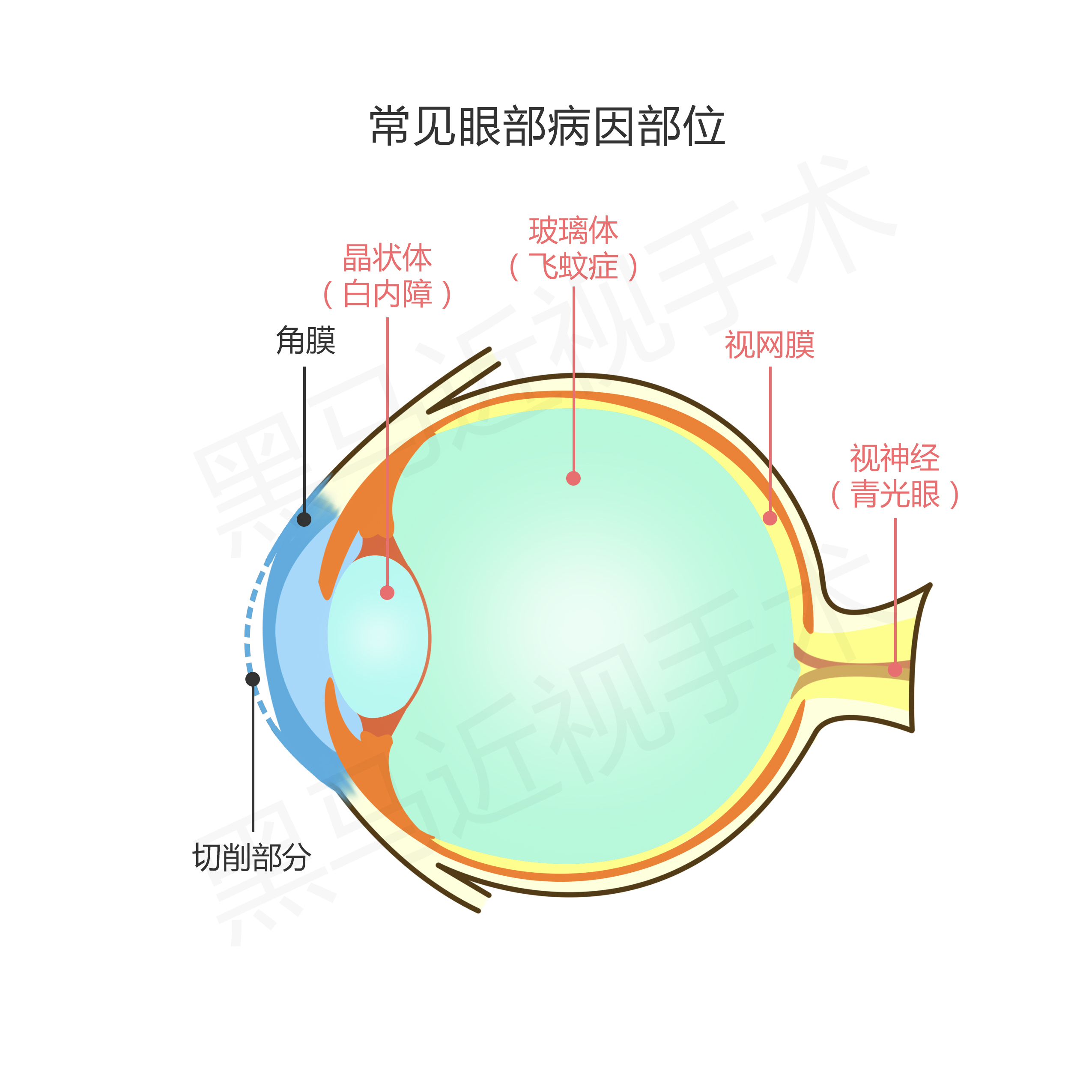 近视300度做激光手术会有后遗症吗,激光近视手术的后遗症有哪些知乎