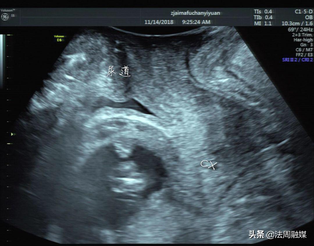 孕妇突发排尿困难，常德妇幼专家：警惕“子宫箝闭”引起的尿潴留