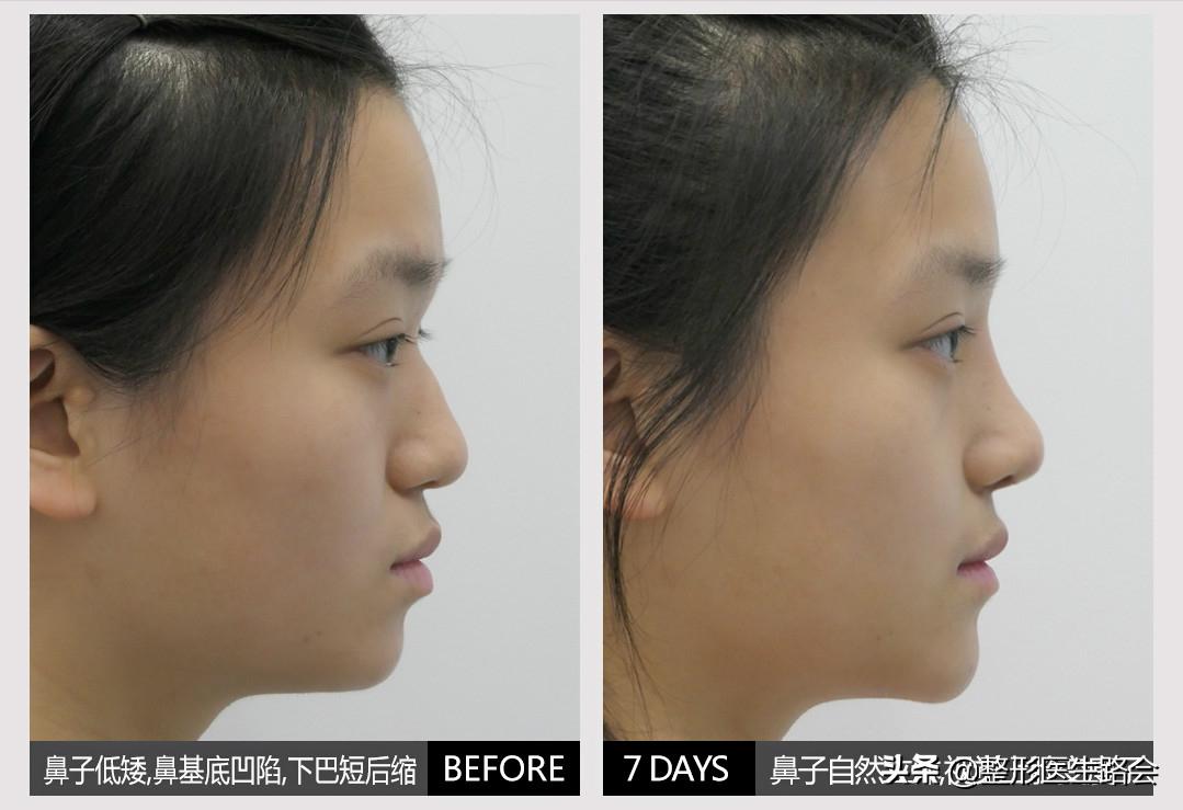 韩式隆鼻是不是就是单纯隆鼻,韩式隆鼻一般要多少钱一次案例