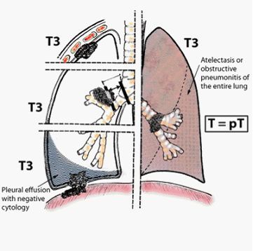肺癌早期和晚期怎么判断,肺癌早中晚期如何区分