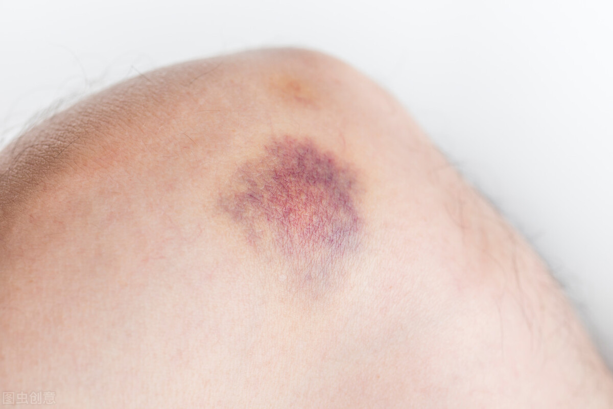 瘀血症中药化瘀的原理,活血化瘀的瘀血从哪排出