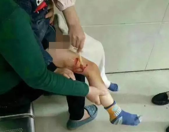 惊险!出门遇到疯狗撕咬孩子!怎么办?急